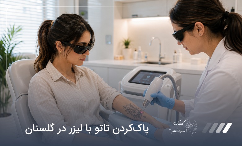 پاک‌کردن تاتو با لیزر در گلستان