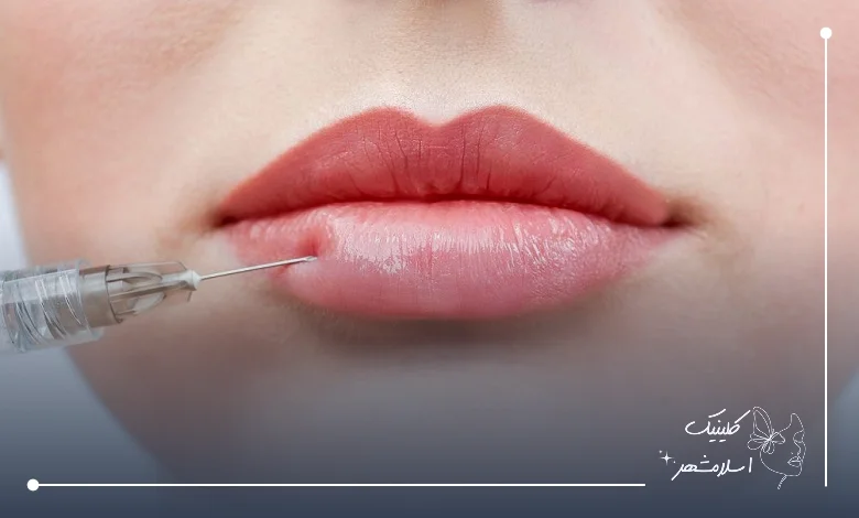 فرایند و مراحل تزریق ژل لب