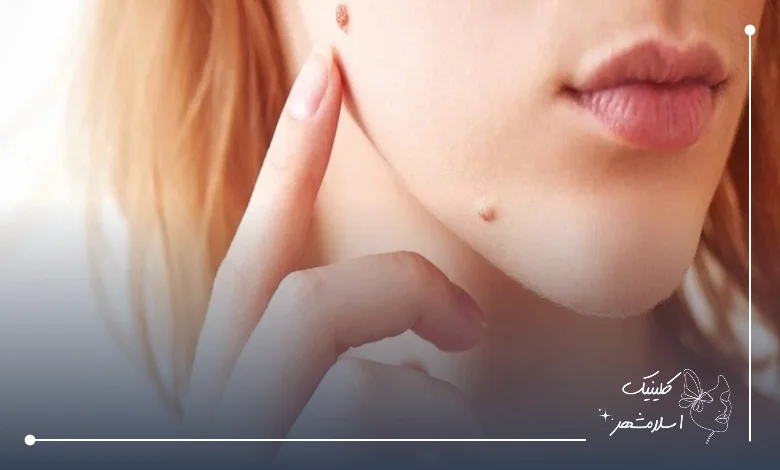 آیا برداشتن خال درد دارد؟