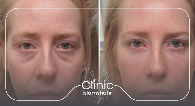 مراحل انجام تزریق ژل زیر چشم