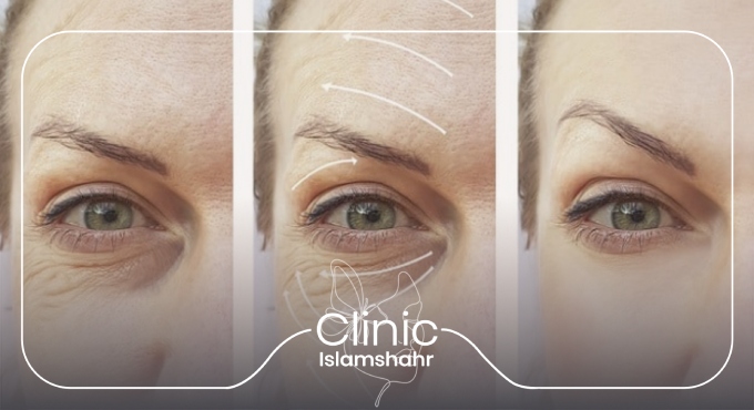 ویژگیهای تزریق ژل زیر چشم در کلینیک اسلامشهر