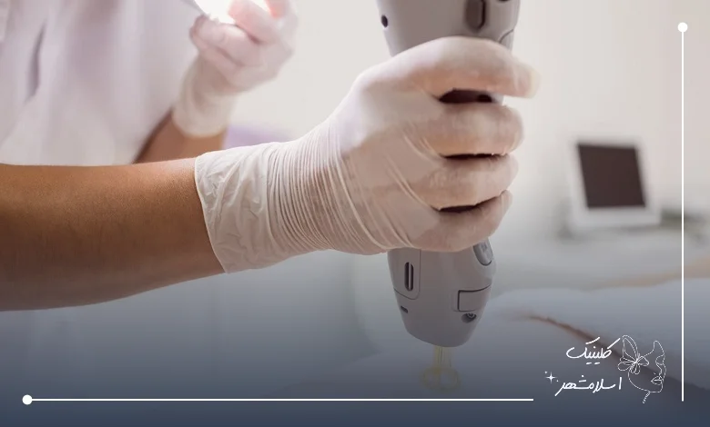 لیزر کندلا برای انواع پوست