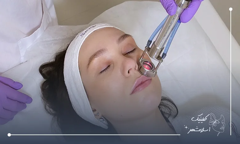 مزایای لیزر موهای صورت در کلینیک اسلام‌شهر
