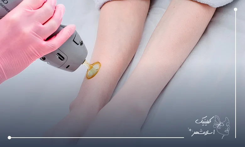 معرفی خدمات لیزر موهای دست در کلینیک اسلام‌شهر