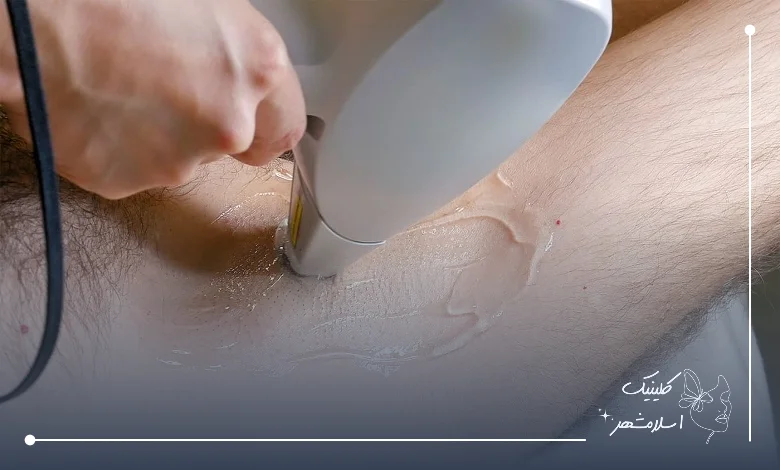 مراحل انجام لیزر زیر بغل در کلینیک اسلام‌شهر