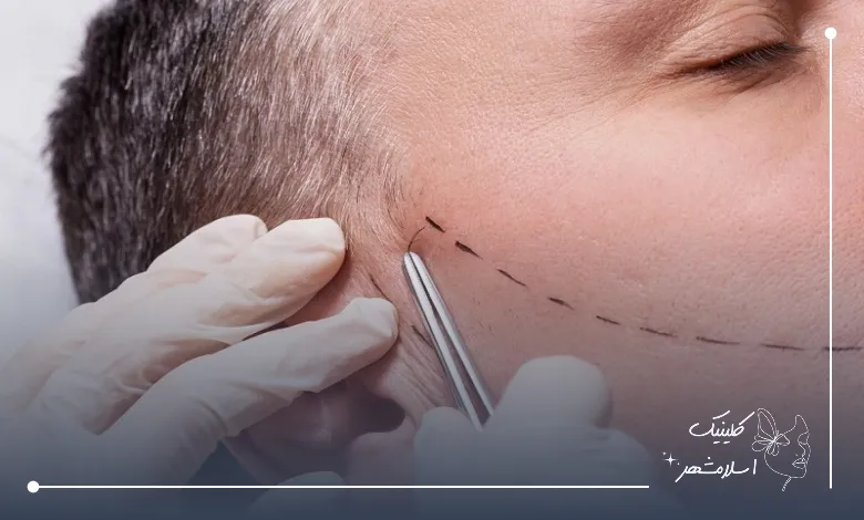 خدمات تخصصی بهترین مرکز کاشت ریش در رباط کریم