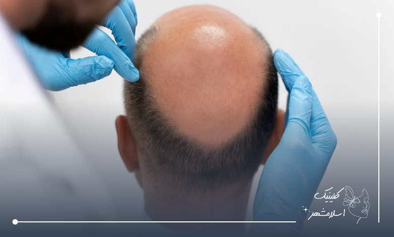 دوران نقاهت کاشت مو و نکات مهم مراقبتی