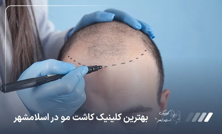 بهترین کلینیک کاشت مو در اسلامشهر【سال1404】⭐