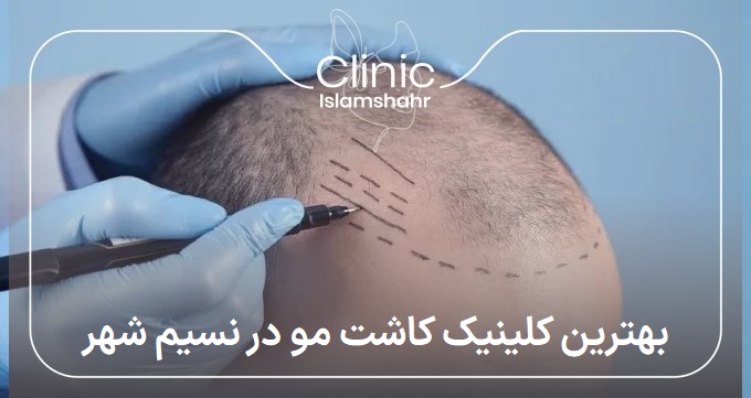 بهترین کلینیک کاشت مو در نسیم شهر