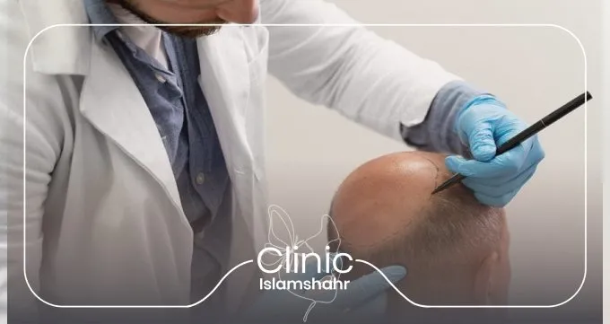 چه افرادی گزینه مناسبی برای کاشت مو هستند؟