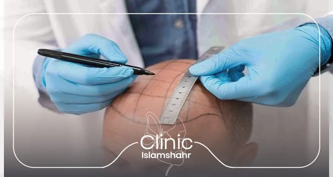 عوارض احتمالی کاشت مو و راه‌های پیشگیری