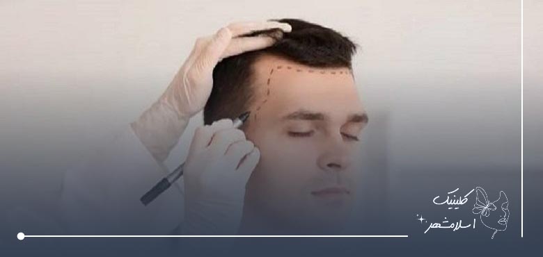 خدمات بهترین کلینیک کاشت مو ارزان در اسلامشهر