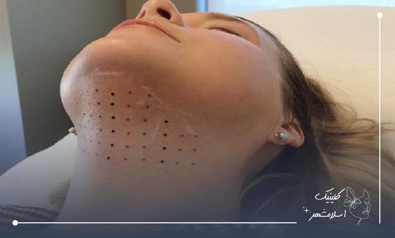 روش‌های مختلف ساکشن غبغب در بهترین مرکز اسلامشهر