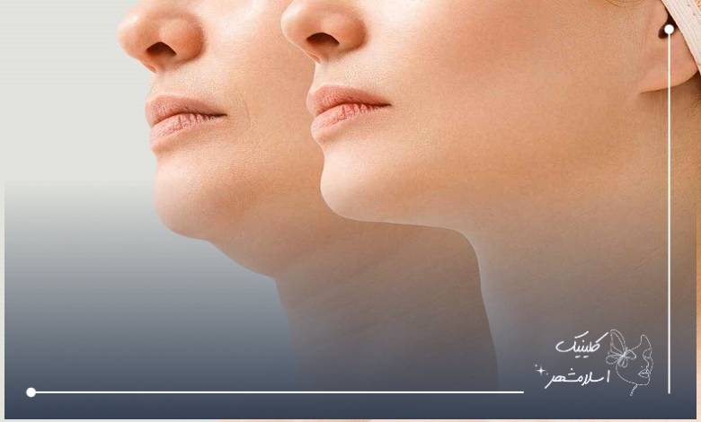 مراقبت‌های بعد از ساکشن غبغب و روند بهبودی