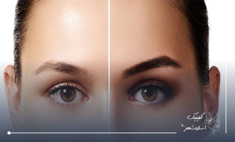 مراقبتهای بعد از کاشت ابرو و پیگیری بهترین کلینیک شهریار