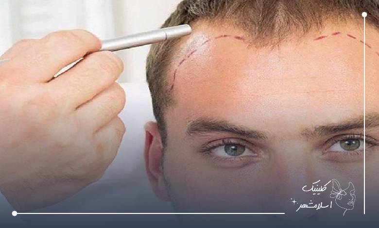 اهمیت مشاوره پیش از عمل در بهترین کلینیک کاشت مو شهریار