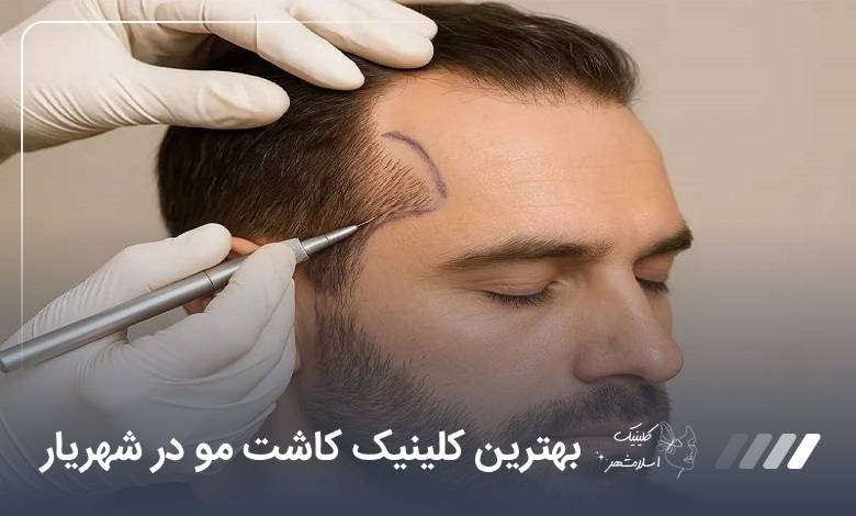 بهترین کلینیک کاشت مو در شهریار【سال1405】❤️