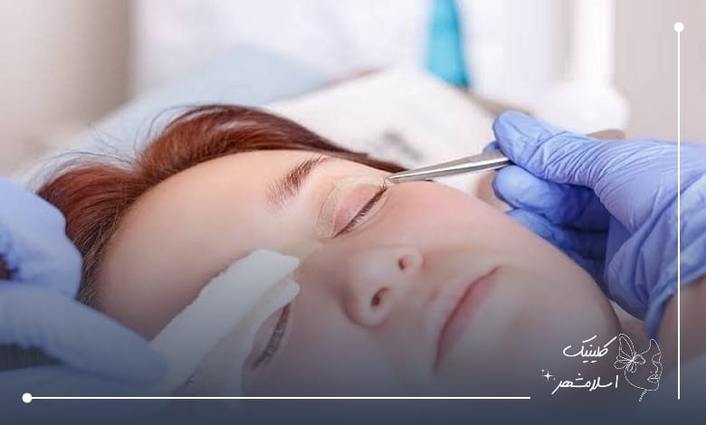 کاندیدای مناسب برای بلفاروپلاستی قسطی 
